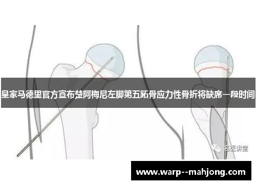 皇家马德里官方宣布楚阿梅尼左脚第五跖骨应力性骨折将缺席一段时间